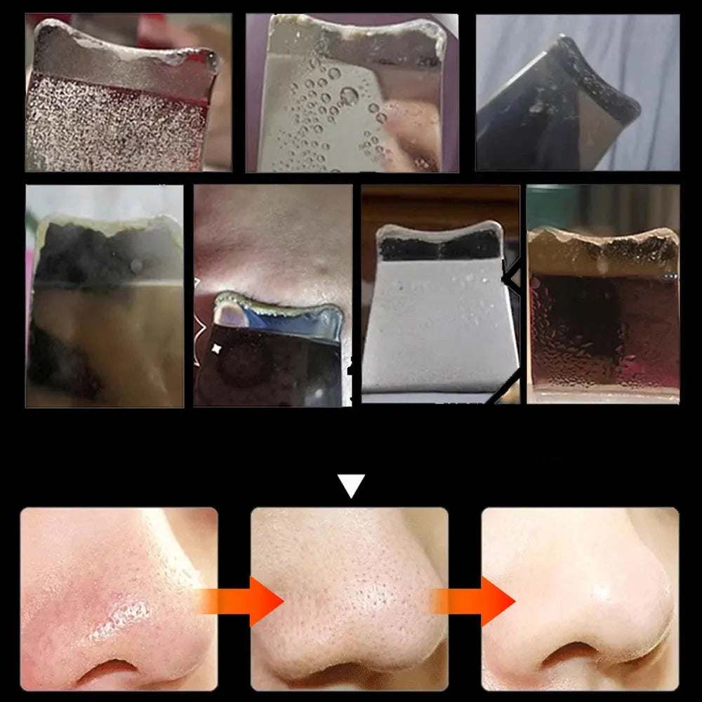 ClearPulse™ Mitesserentferner | Die Lösung für unerwünschte Mitesser